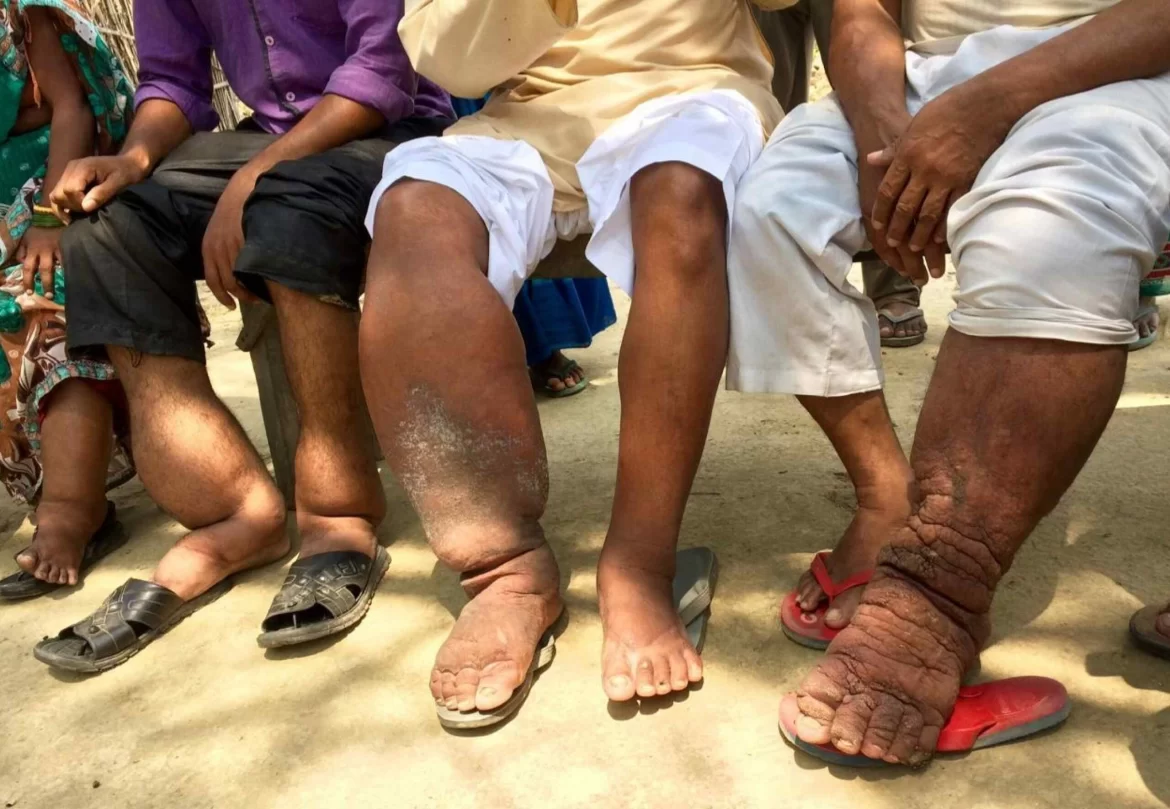 elephantiasis